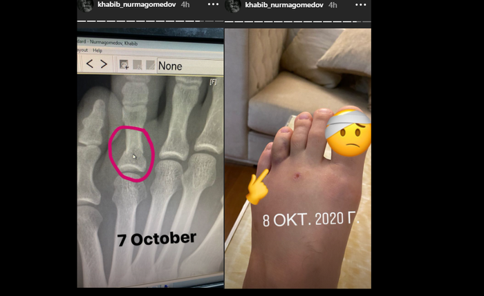 Khabib Nurmagomedov mengunggah cedera jari kaki patah di Instagram melalui fitur story pada Selasa (27/10/2020). 