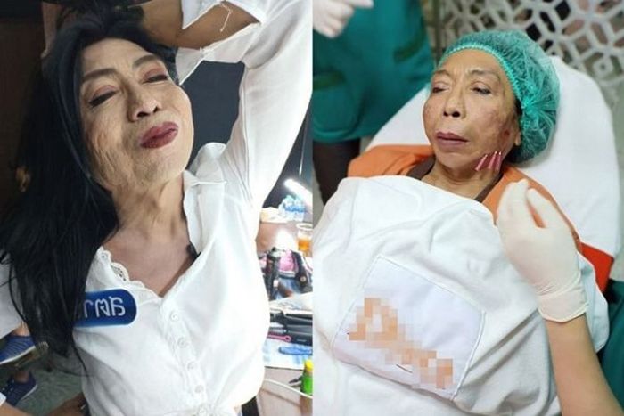 Sitang Buathong operasi plastik.