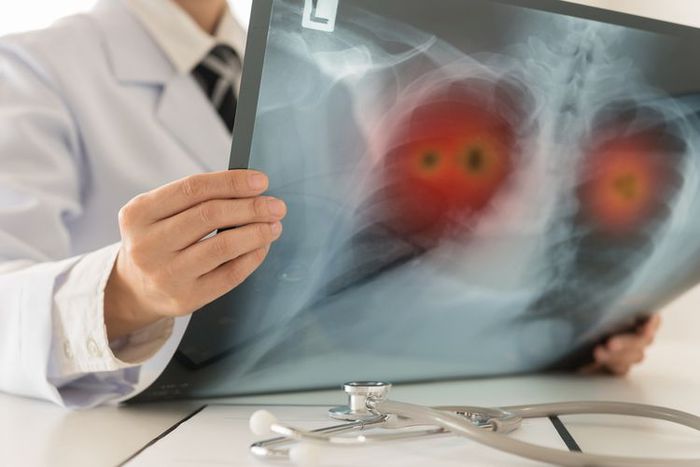 Ilustrasi - Infeksi Covid-10 yang sudah menjadi pneumonia.