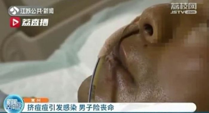 Seorang pria hampir meninggal hanya karena memencet jerawat di wajahnya, rupanya begini ceritanya