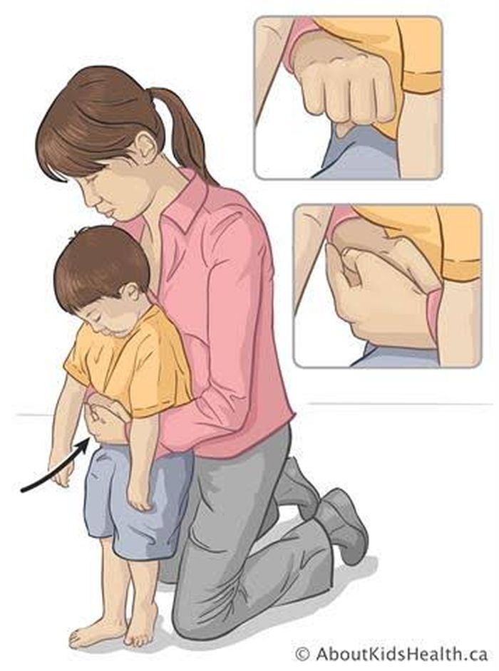 Teknik heimlich maneuver untuk anak di atas 1 tahun dalam pertolongan pertama saat tersedak