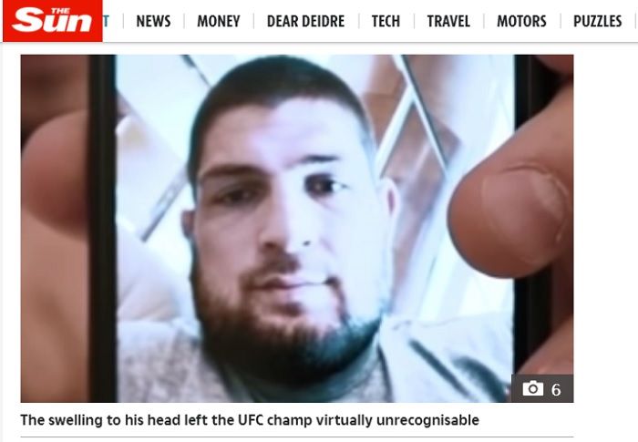 Wajah juara dunia UFC kelas ringan, Khabib Nurmagomedov saat menderita sakit gondongan.