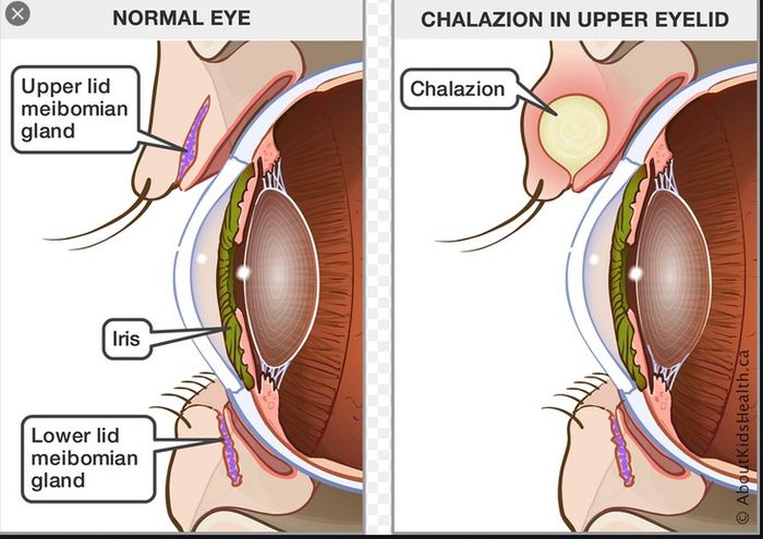 Chalazion
