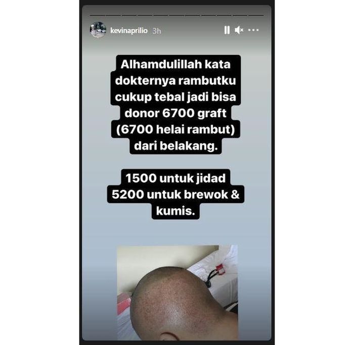 Penjelasan Kevin Aprilio soal transplantasi rambut