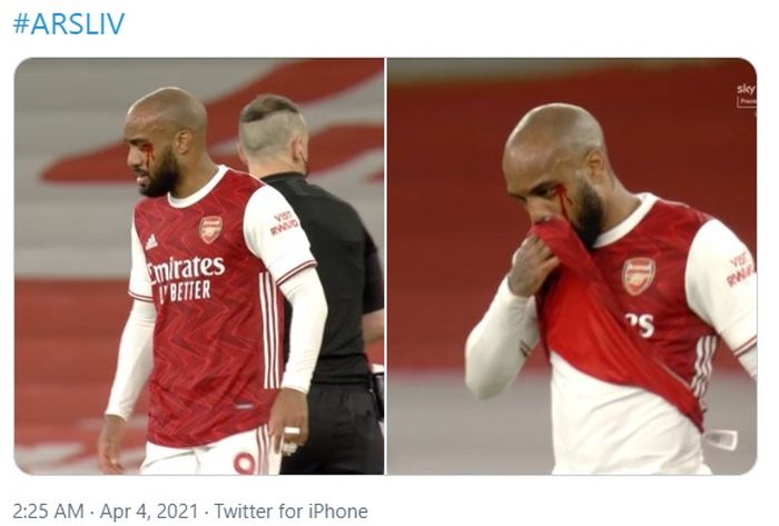 Striker Arsenal, Alexandre Lacazette, mengalami pendarahan di bagian pelipis mata sebelah kiri usai disikut oleh bek Liverpool, Nat Phillips.