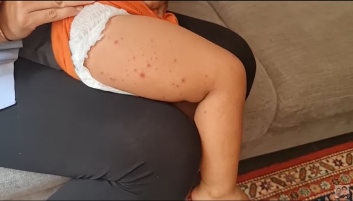 Kiano positif flu singapura dan muncul bintik-bintik merah di seluruh tubuh