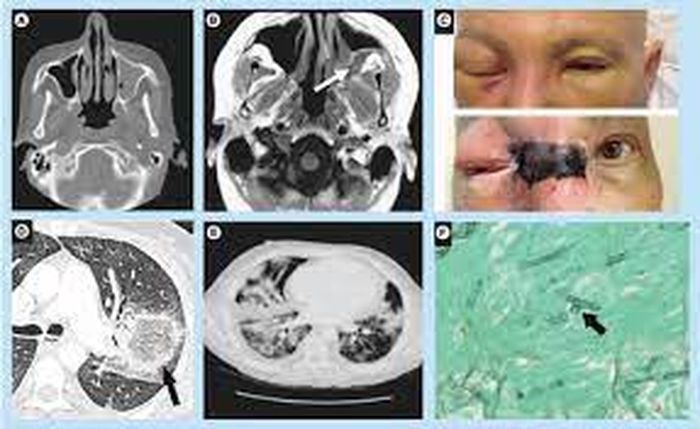 Infeksi Jamur Hitam di India Serang Pasien Komorbid Diabetes, 6
