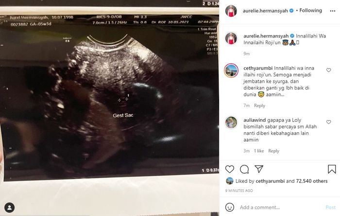 Instagram @aurelie.hermansyah
 Aurel Hermansyah keguguran