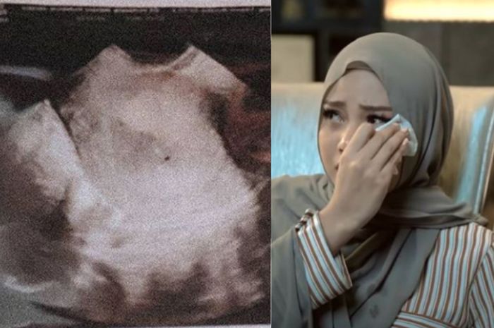 Diceritakan oleh Aurel, dirinya sempat mengalami pendarahan sebelum keguguran.