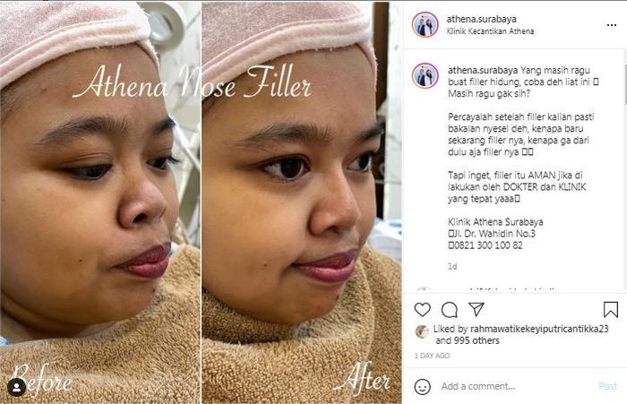 Foto perubahan wajah Kekeyi sebelum dan sesudah menjalani filler hidung.