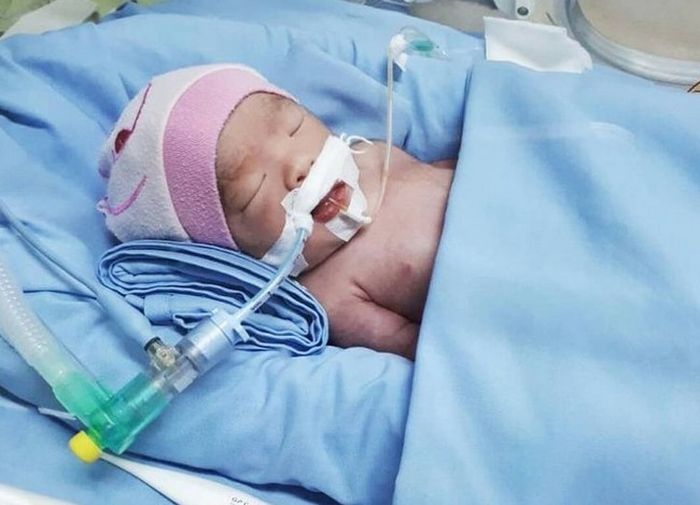 Bayi di intubasi di NICU
