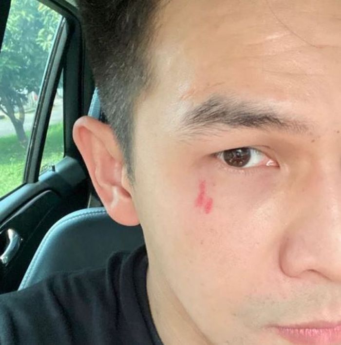 Luka di wajah Jonathan Frizzy yang diduga sebagai bentuk KDRT yang dilakukan Dhena Devanka