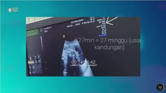Hasil USG kandungan Lesti Kejora yang sempat dijadikan story oleh Rizky Billar, diunggah Rabu (6/10/2021). 