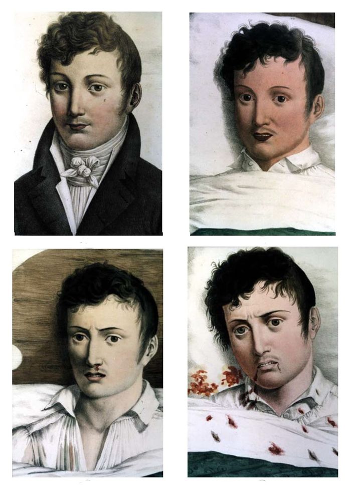 Perkembangan demam kuning pada seorang bangsawan muda. Pada 1820-an kawasan Gibraktar berjangkit epidemi demam kuning yang hebat.