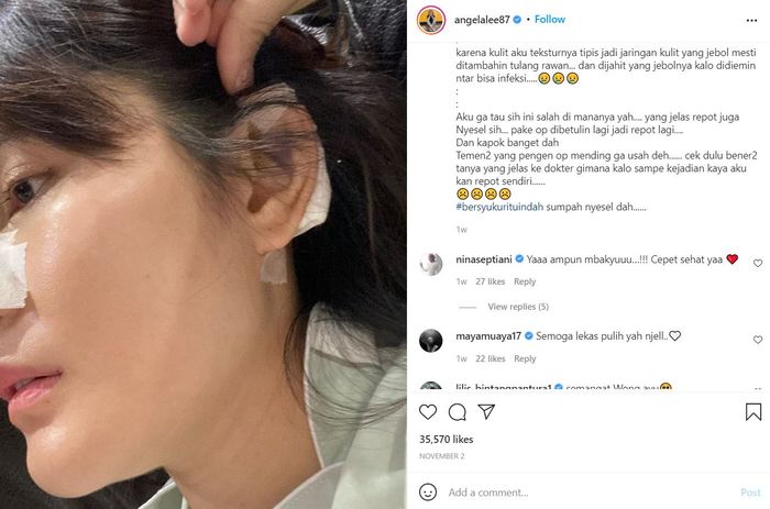 Angela Lee gagal implan wajah