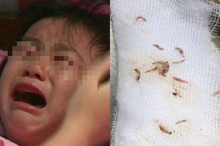 Belatung ada di dalam telinga bocah ini