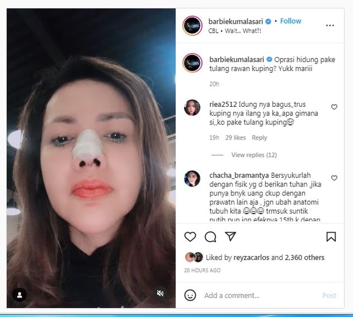 Barbie Kumalasari setelah operasi hidung