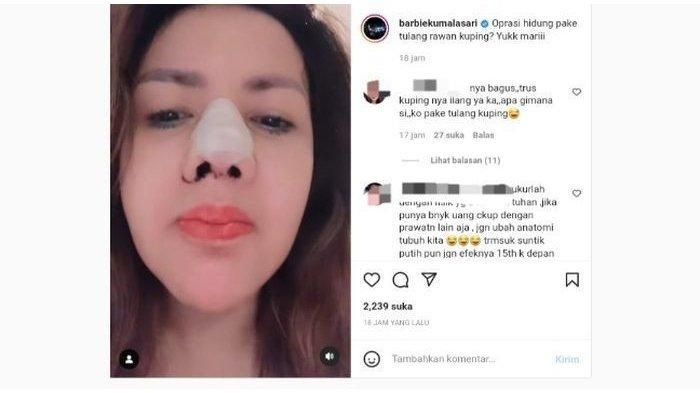 Barbie Kumalasari yang gagal saat filler hidung