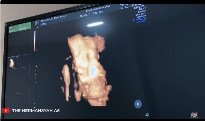 Hasil USG calon anak Aurel Hermansyah