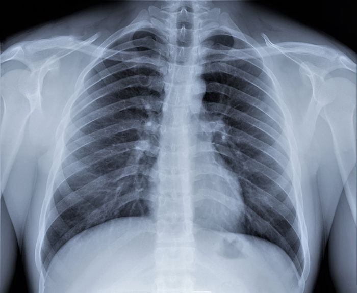 Tampilan hasil ronten paru-paru diagnosis pneumonia coronavirus.