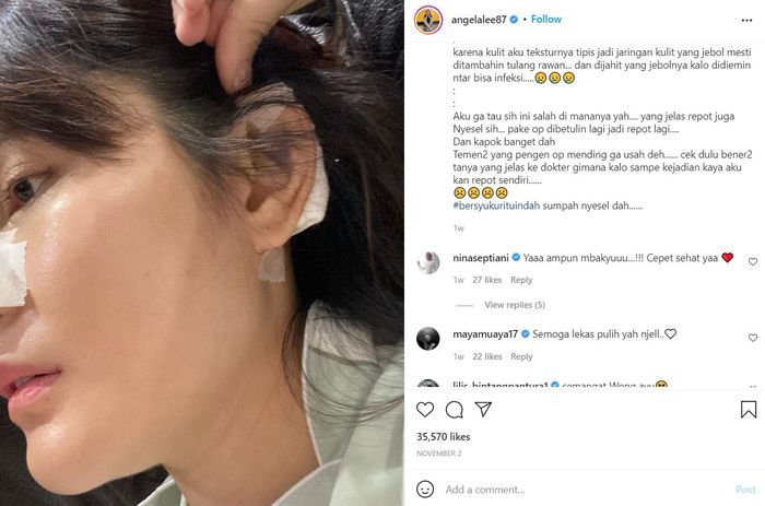 Angela Lee kapok operasi plastik