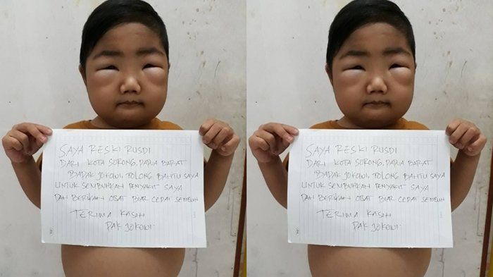 Seorang anak dengan sindrom nefrotik.