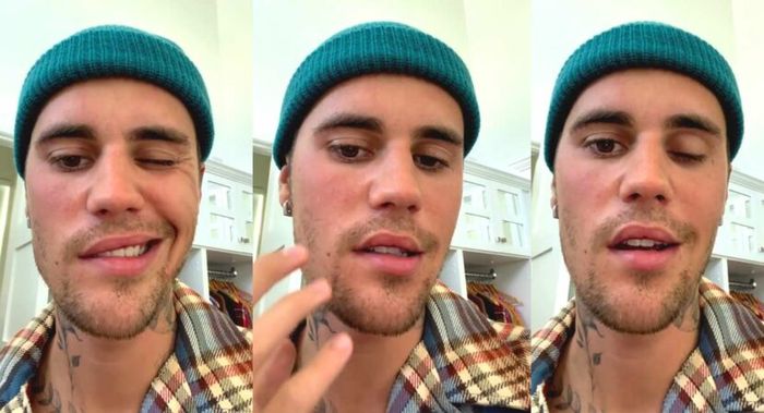 Wajah Justin Bieber lumpuh karena sindrom Ramsay Hunt.