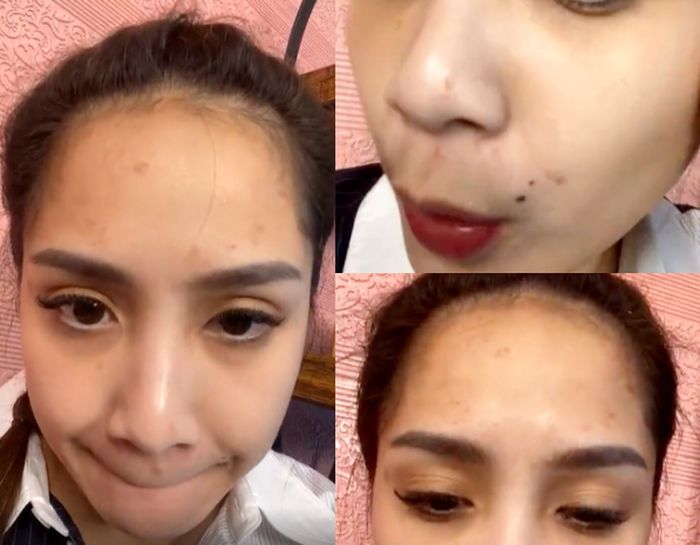 Tampilan wajah Nagita Slavina dengan jerawat