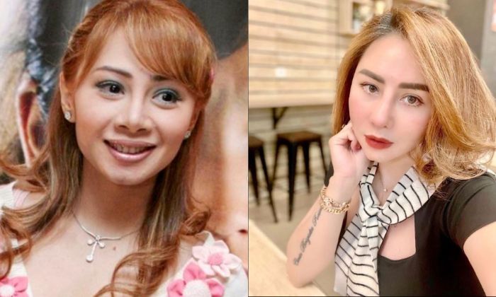 Artis Femmy Permatasari menjalani operasi plastik.
