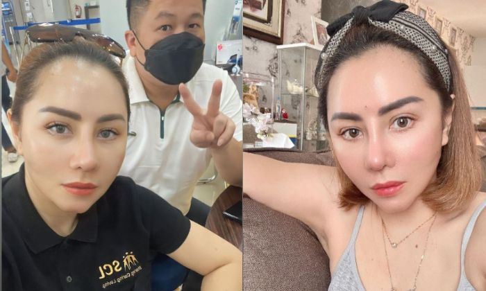 Potret Femmy Permatasari usai menjalani operasi plastik.