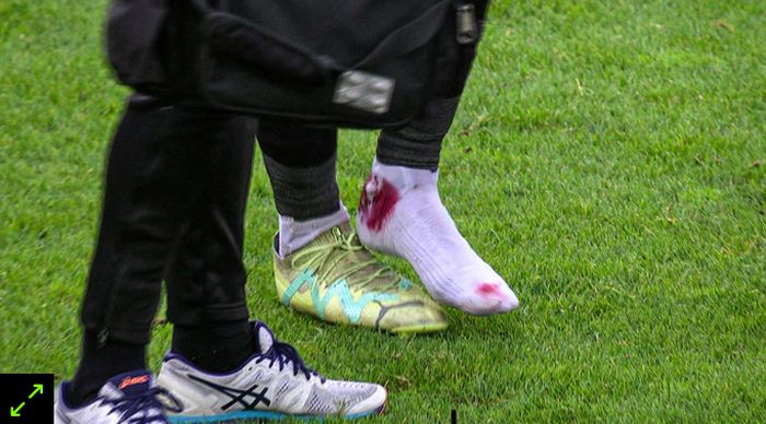 Foto kaki bek timnas Indonesia, Sandy Walsh yang mengalami cedera hingga kakinya berdarah. 