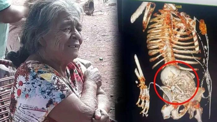 Seorang wanita meninggal setelah ada janin batu di tubuhnya