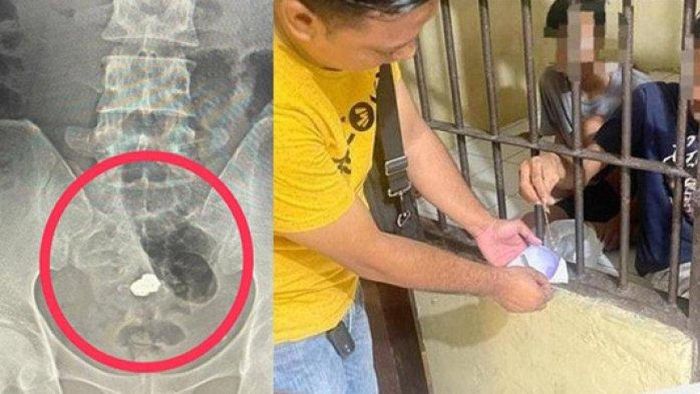 Hasil rontgen setelah seorang pencuri menelan emas hasil curiannya