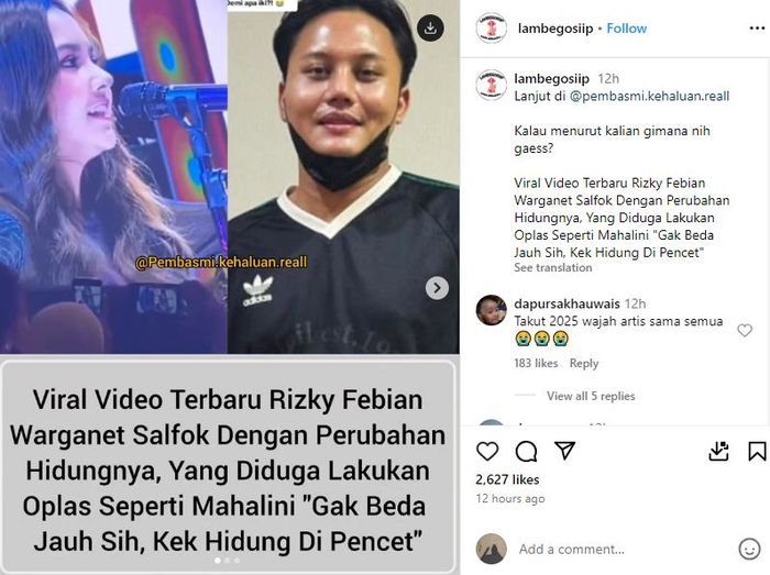 Rizky Febian ternyata juga jalani operasi wajah