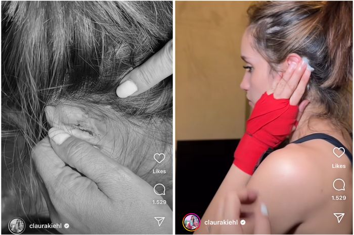 Cinta Laura mengalami cedera bagian telinga akibat salah tendang lawan mainnya saat syuting series aksi. 