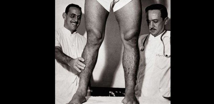 Kondisi kaki Garrincha yang abnormal diperlihatkan oleh dokter.
