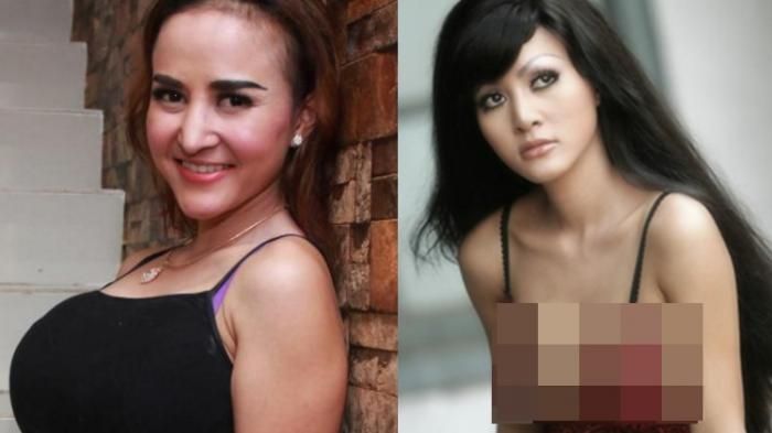 Cynthiara Alona sebelum dan sesudah operasi plastik