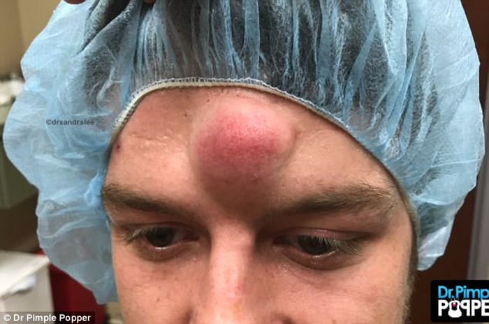 Awalnya Dikira Lemak Setelah Diperiksa Dokter Isi Benjolan Di Dahi Pria Ini Bikin Shock Ternyata Ini Yang Dialaminya Semua Halaman Pop Grid Id