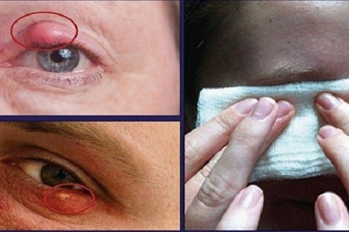 Cara Tepat Atasi Bintitan Pada Mata Agar Tak Berkembang Jadi Infeksi -  Semua Halaman - Grid Health