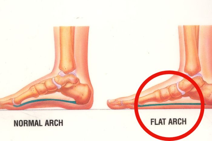 Telapak Kaki Rata Asia