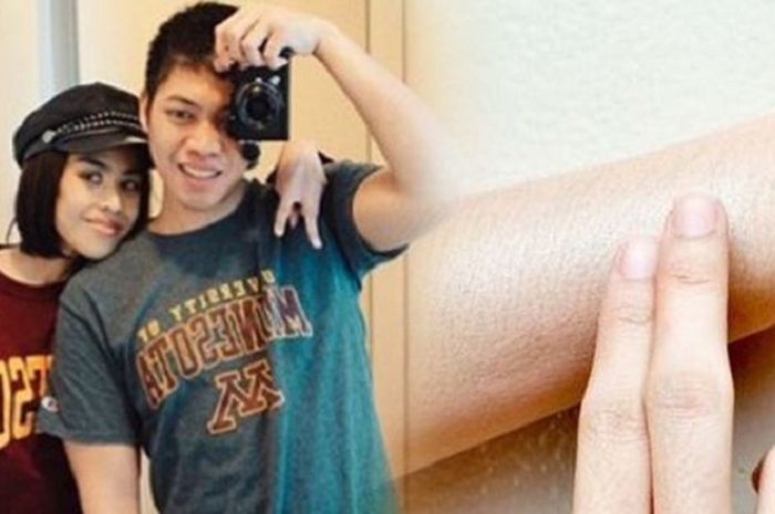 Adara Taista Diduga Meninggal karena Kanker Kulit: Kenali Penyebab dan