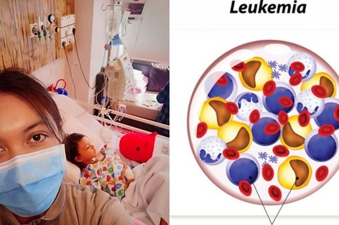 Ciri Ciri Leukemia Pada Orang Dewasa - Ini Cirinya