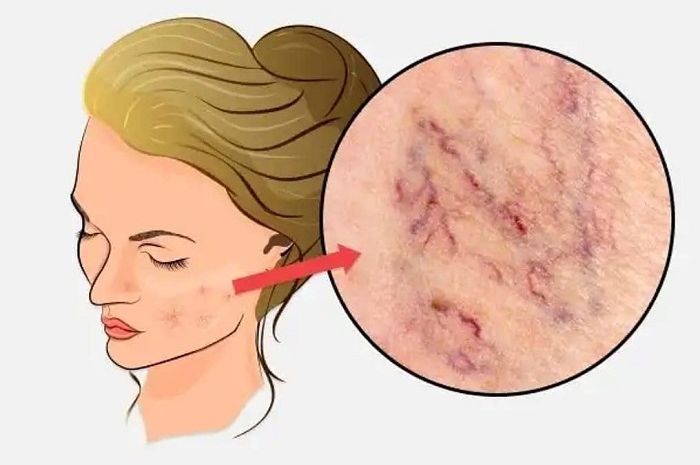 comentarii despre varicose facial