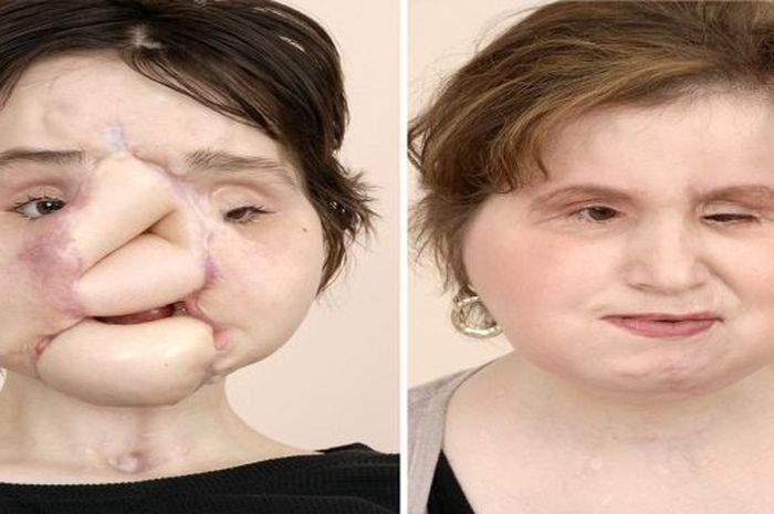 Inilah Transformasi Wajah Katie Stubblefield Si Penerima Transplantasi Wajah Dari 7 Orang Lainnya Semua Halaman Intisari Inilah Transformasi Wajah Katie Stubblefield Si Penerima Transplantasi Wajah Dari 7 Orang Lainnya Semua Halaman Intisari