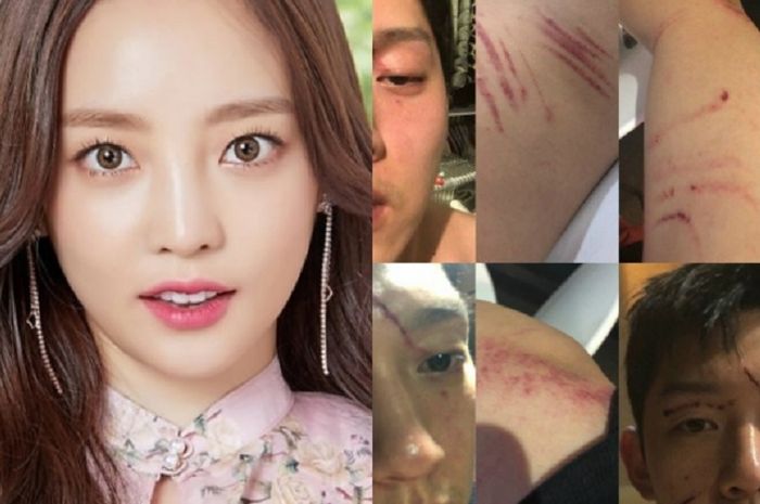 Choi Jung Bum Rilis Foto Cakaran Goo Hara Usai Dilaporkan karena Kekerasan ...