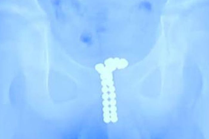 Hasil X-Ray