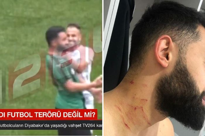 Lewat Instastory-nya, kapten Sakaryaspor, Ferhat Yazgan, memamerkan lehernya yang terluka akibat ulah pemain Amed SK, Mansur Calar.