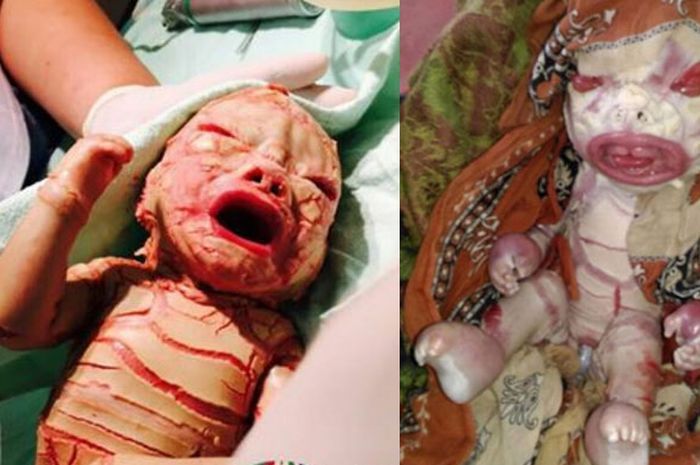 Dua bayi Ichthyosis Harlequin (bukan Dania), kiri lahir di Malaysia, kanan lahir di India.