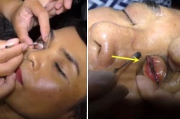 Klinik Layanan Pembersih Dalam Kelopak Mata