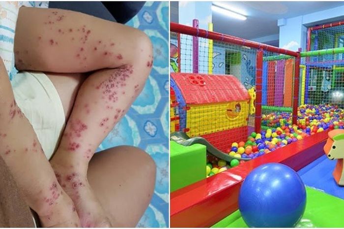 Balita Ini Tertular Flu Singapura Setelah Habiskan Waktu di Wahana